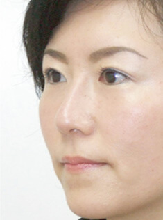 症例写真２（Ｉ型オーダーメイドプロテーゼ隆鼻術＋鼻中隔延長術）