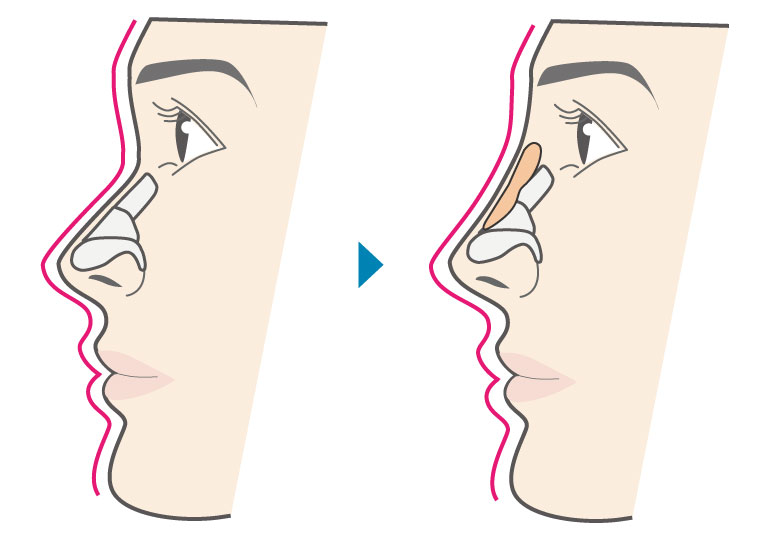 プロテーゼによる隆鼻術