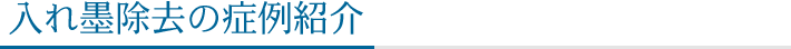 入れ墨除去の症例紹介