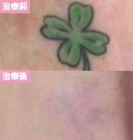 ピコレーザー3回治療後