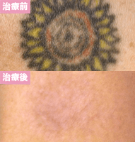 ピコレーザー3回治療後