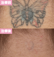ピコレーザー6回治療後
