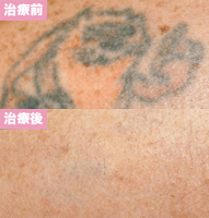 ピコレーザー3回治療後