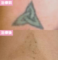 ピコレーザー2回治療後