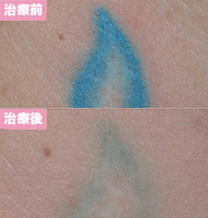 ピコレーザー3回治療後