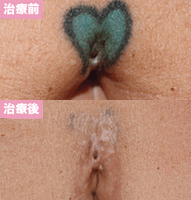 ピコレーザー3回治療後