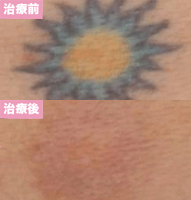 ピコレーザー6回治療後