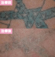 ピコレーザー2回治療後