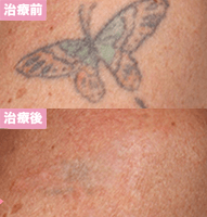 ピコレーザー7回治療後