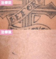 ピコレーザー4回治療後