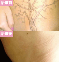 ピコレーザー3回治療後