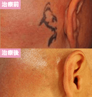 ピコレーザー2回治療後