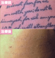 ピコレーザー3回治療後