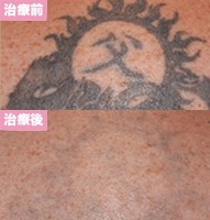 ピコレーザー4回治療後