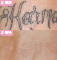 ピコレーザー3回治療後