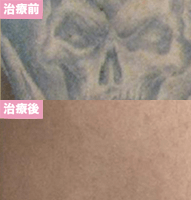 ピコレーザー4回治療後