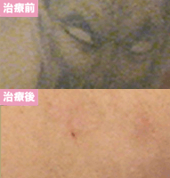 ピコレーザー4回治療後