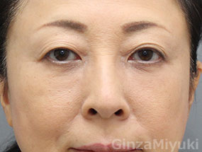 症例270 モニター 58歳女性 美容整形なら銀座みゆき通り美容外科 東京銀座 大阪梅田