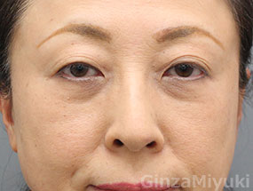 症例270 モニター 58歳女性 美容整形なら銀座みゆき通り美容外科 東京銀座 大阪梅田