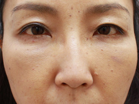 症例63 モニター 48歳女性｜美容整形なら銀座みゆき通り美容外科 東京