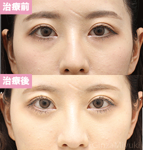 症例292 モニター 24歳女性