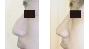 ワシ鼻修正術の実例