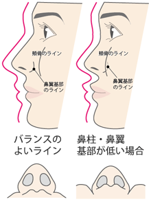 鼻柱・鼻翼基部と顔のライン・立体感
