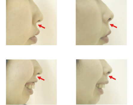 鼻柱基部形成術の実例
