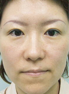 症例写真（Ｉ型オーダーメイドプロテーゼ隆鼻術＋鼻尖縮小術）