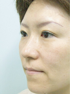 症例写真（Ｉ型オーダーメイドプロテーゼ隆鼻術＋鼻尖縮小術）