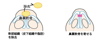 鼻尖形成術（鼻尖縮小術）の方法