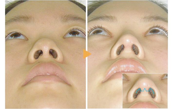 症例写真１（Ｉ型オーダーメイドプロテーゼ隆鼻術＋鼻中隔延長術）