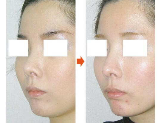 症例写真２（Ｉ型オーダーメイドプロテーゼ隆鼻術＋鼻中隔延長術）