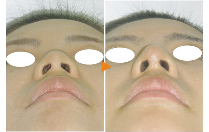 症例写真３（Ｉ型オーダーメイドプロテーゼ隆鼻術＋鼻中隔延長術）