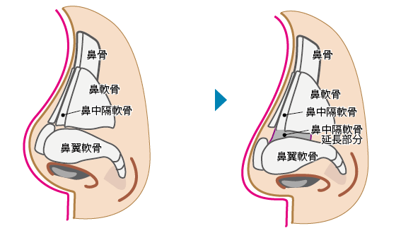 鼻中隔延長術（鼻先延長術）の方法