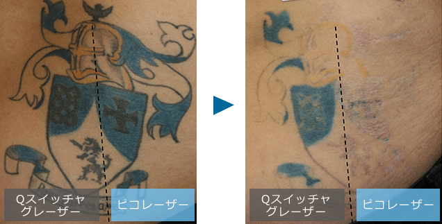 刺青治療レーザーの比較・実際のタトゥーで実証