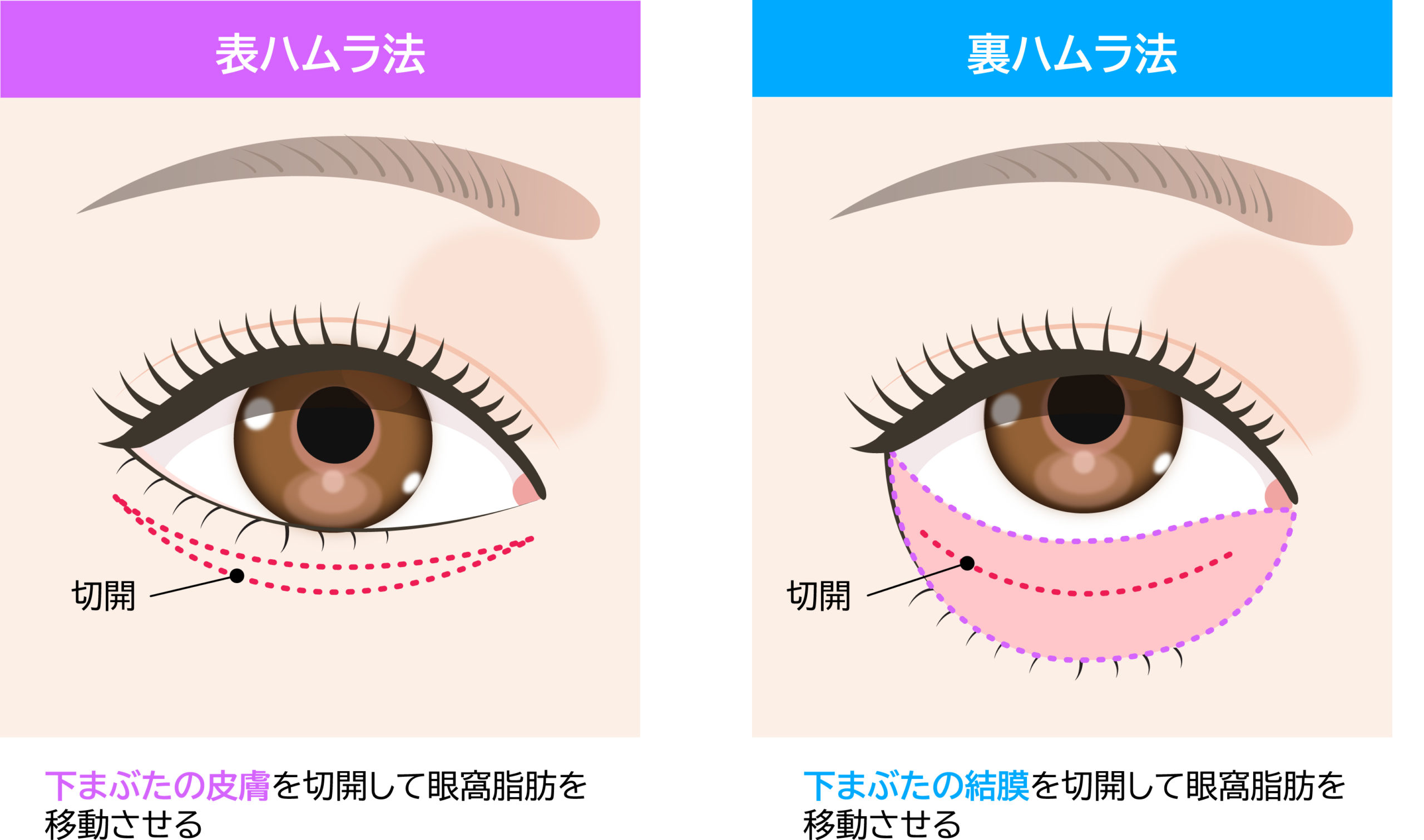 ハムラ法・裏ハムラ法のメリット＆デメリット｜目の下のクマ・たるみを根本改善するには？ | 銀座みゆき通り美容外科の美容コラム  ｜美容整形｜東京・中央区・銀座｜大阪・梅田